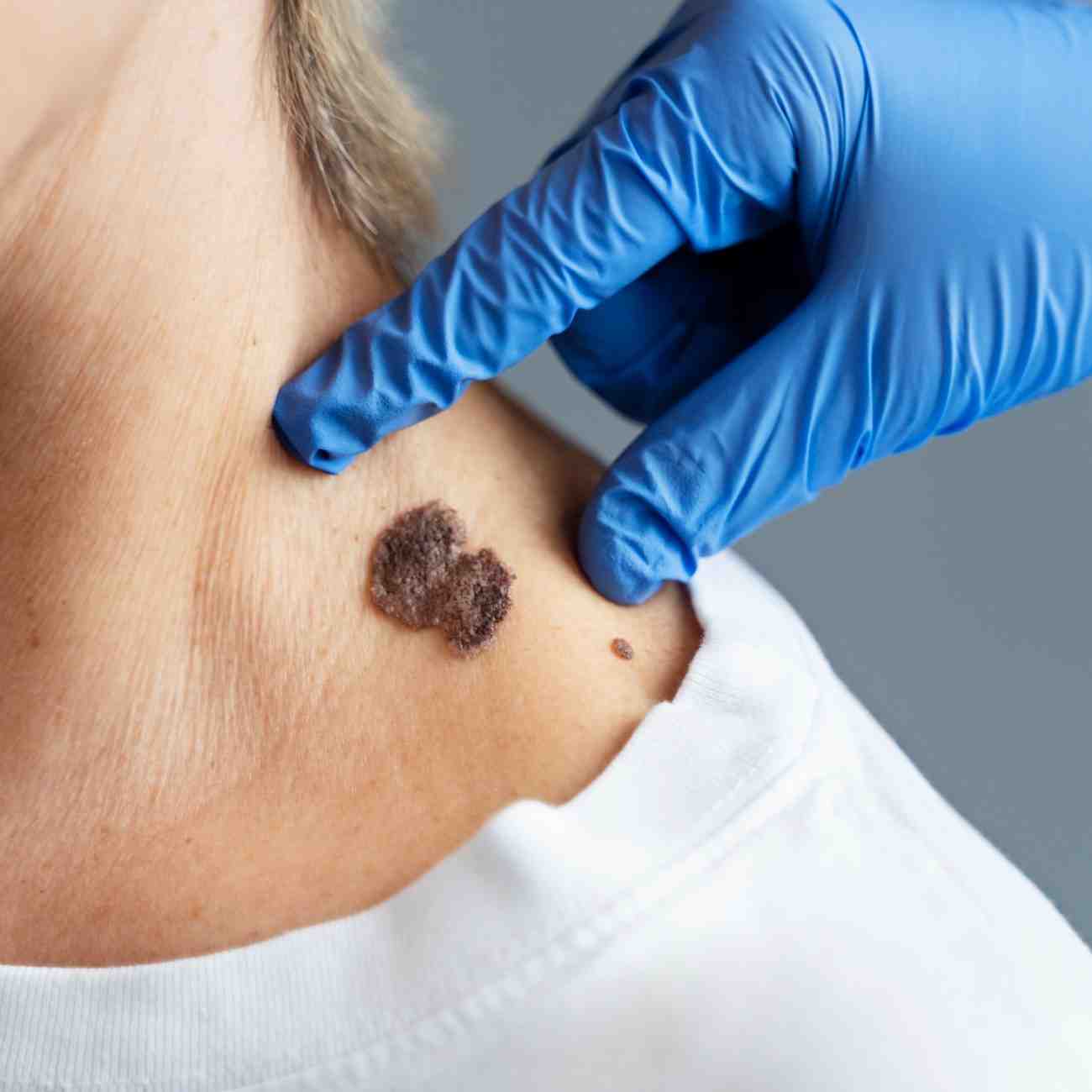 Warts Care