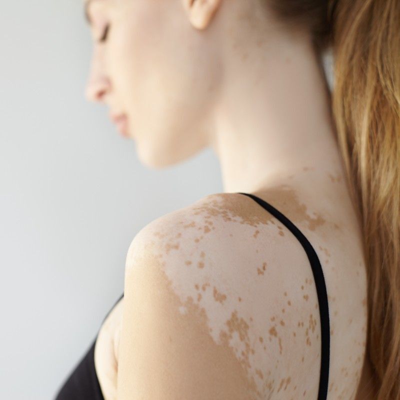 Skin Cancer